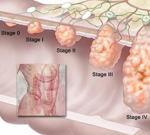 Signs and symptoms of cancer