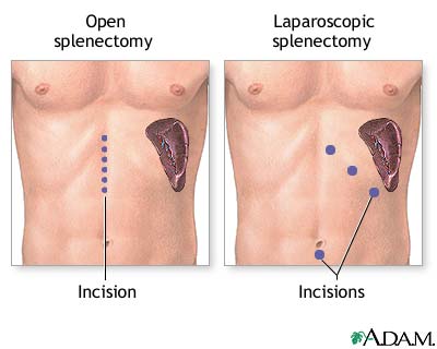 Splenectomy - Removal of spleen