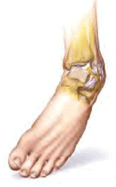 Sprains and Strains - symptoms and treatment