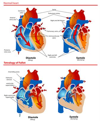 Tetralogy of Fallot