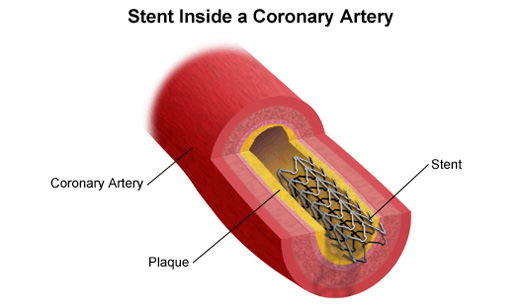 Stent definition and Stents in arteries
