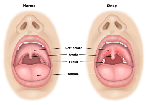 Strep throat - symptoms and treatment