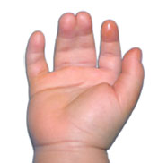Syndactyly - definition and treatment