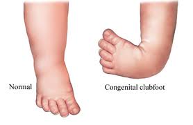 Talipes Equinovarus - definition and treatment
