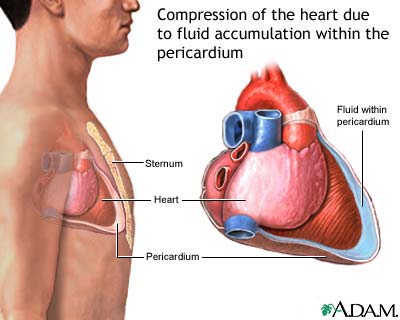 Tamponade, cardiac - definition