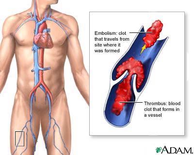 Thrombolytic Therapy definition