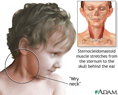 Torticollis - wryneck - definition, causes, diagnosis and treatment