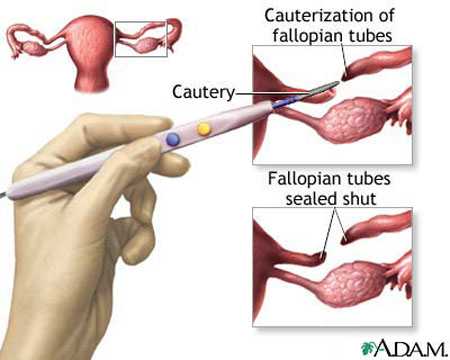 Tubal Ligation procedure - risks, side effects