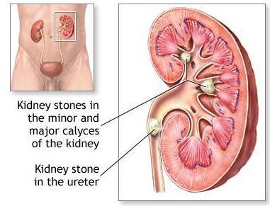 Uremia - definition, signs, symptoms and treatment