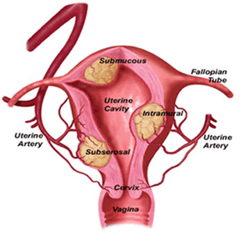 Uterine Fibroids - symptoms and treatment