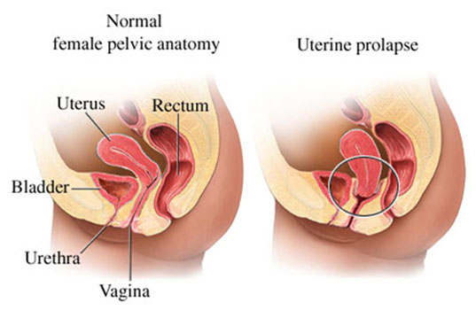 Uterine Prolapse - symptoms and treatment