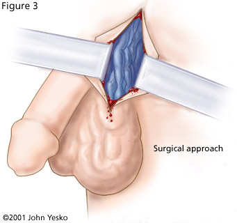 Varicocele - definition, symptoms, treatment and surgery