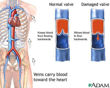 Chronic Venous Insufficiency - symptoms and treatment