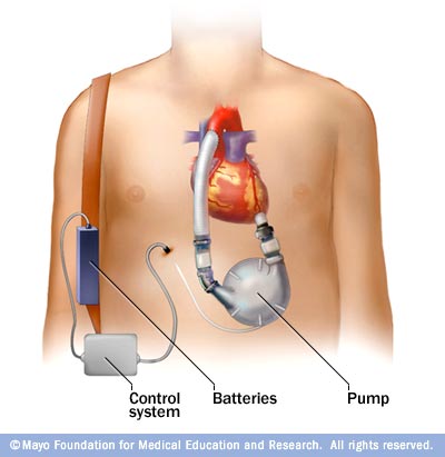 Ventricular assist devices (VADs)