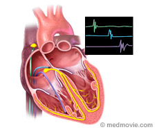 Electrophysiology study (EPS) - diagnostic procedure heart