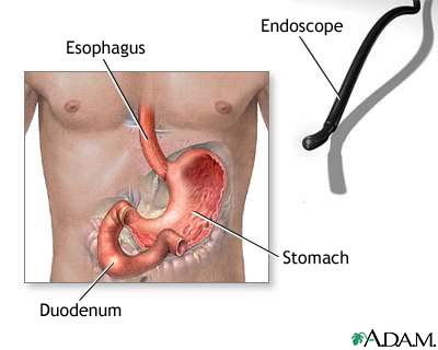 Endoscopy procedure